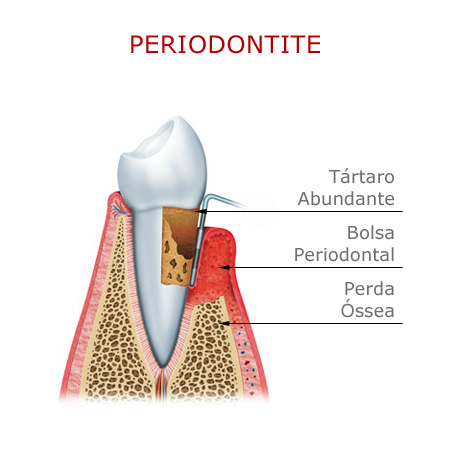 Periodontia em Santos